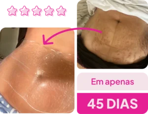 Resultado do tratamento ADEUS em apenas 45 dias, com avaliação 5 estrelas e comparação da pele
